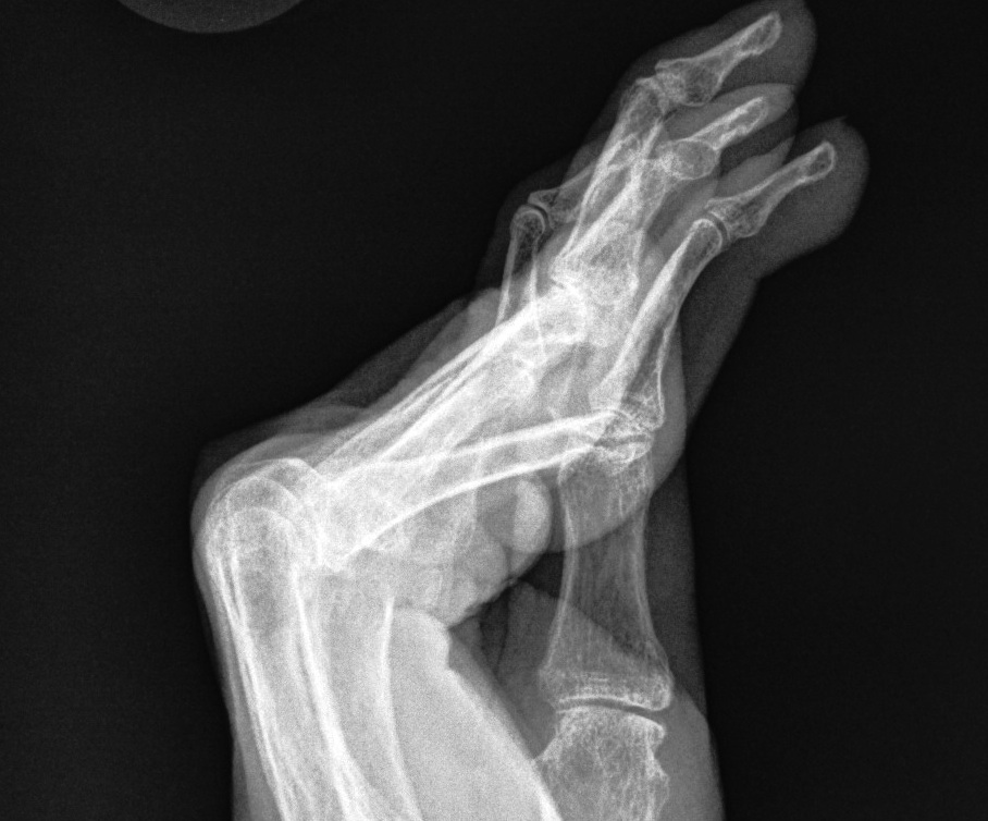 Rheumatoid Swan Neck secondary to MCPJ